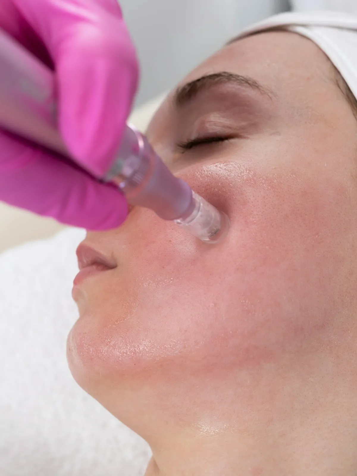Microneedling – Behandlungsgerät